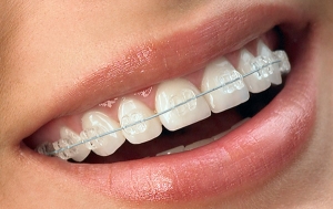 noot gips Meestal Behandelmethode – Orthodontiepraktijk Ortho Dordt
